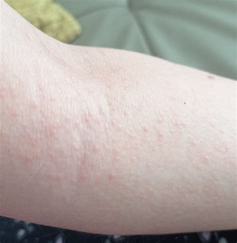 Vyrážky na rukách a nohách pri HFMD