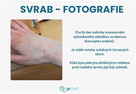 Ilustrácia nórskeho svrabu na pokožke