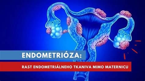 Ilustrácia endometriózy v ženskom tele