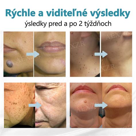 Vzhľad genitálnych bradavíc