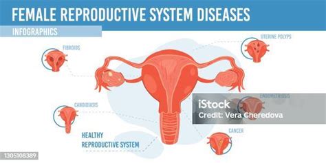 Infografika znázorňujúca ženské reprodukčné orgány a bežné gynekologické problémy
