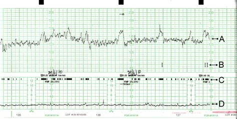 CTG záznam srdcovej činnosti plodu