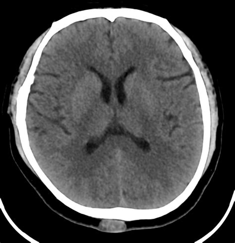 Röntgen lebky a CT scan mozgu
