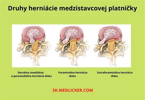 Schematické znázornenie herniácie medzistavcovej platničky