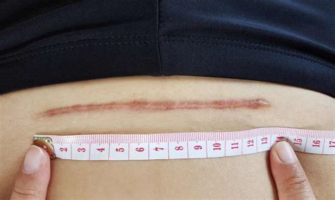 žena po cisárskom reze