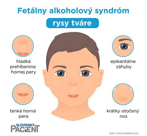 fetálny alkoholový syndróm