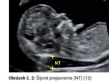 Ultrazvukové meranie NT (šijové prejasnenie)