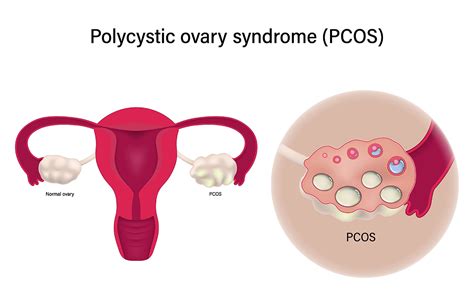 Schéma liečby PCOS a podpory ovulácie