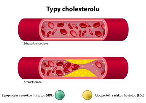 Vplyv stravovania na hladinu cholesterolu