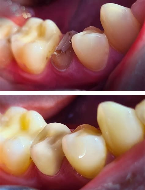 Porovnanie stavu zuba pred a po oprave