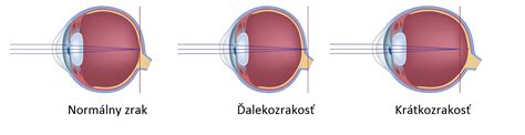 Schéma porovnania metód laserovej operácie oka