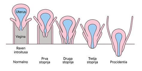 Ilustrácia maternice po kyretáži