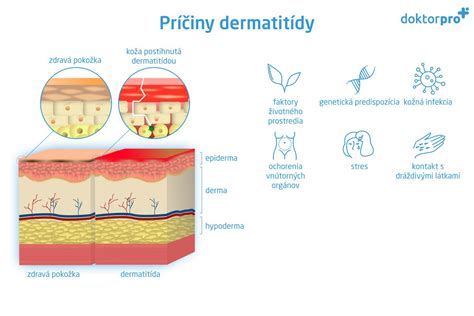 Ilustrácia plienkovej dermatitídy