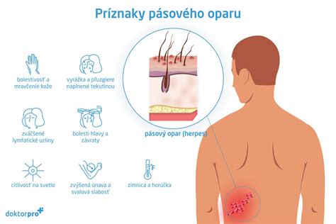 Ilustrácia pásového oparu na tele