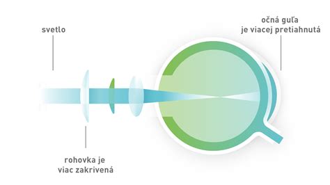 Ilustrácia správneho postupu pri vyplachovaní oka