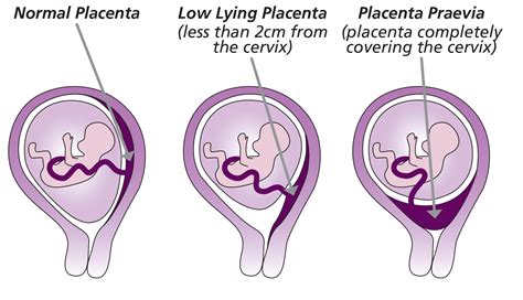 Vizualizácia placenta praevia