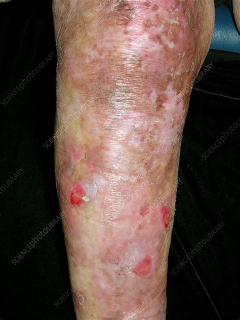 koláž fotografií detí s epidermolysis bullosa