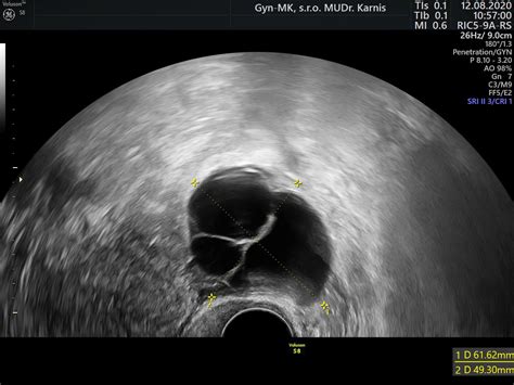 Ultrazvukové zobrazenie vaječníka s folikulmi