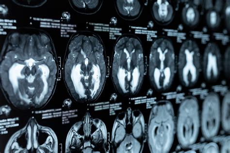 Infografika porovnávajúca CT a MRI mozgu