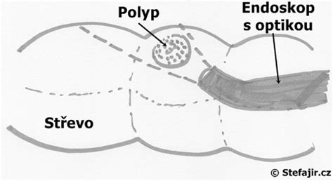 Schéma hysteroskopického odstránenia polypu