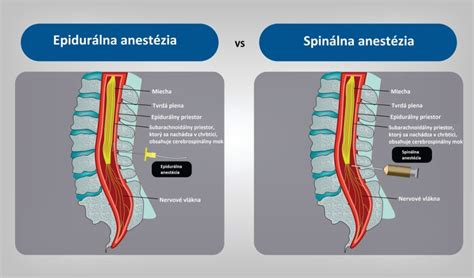 Infografika zobrazujúca priebeh pôrodu s epidurálnou analgéziou