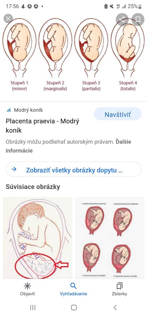 Ilustrácia možných pôrodných poranení