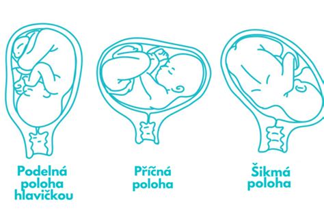 Infografika ukazujúca rôzne polohy plodu