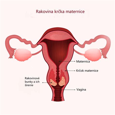 grafické znázornenie otvárania krčka maternice