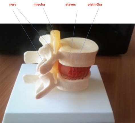 Anatomické znázornenie epidurálneho priestoru v chrbtici