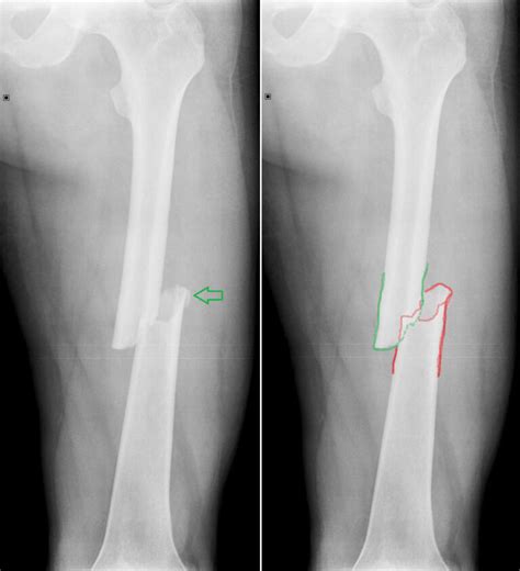 Röntgenový snímok zlomeniny kľúčnej kosti u novorodenca