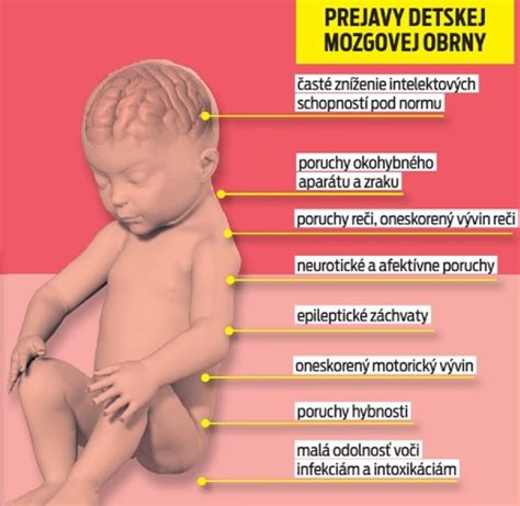 príčiny detskej mozgovej obrny