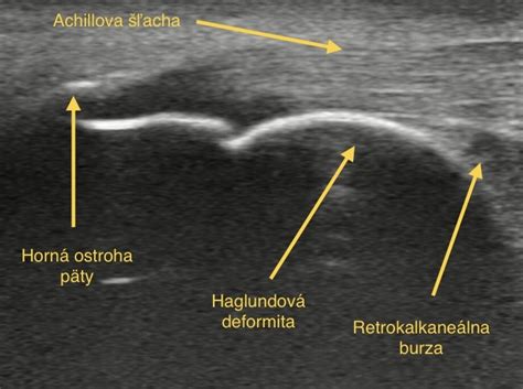 Schematické znázornenie biopsie prsníka pod ultrazvukovou kontrolou