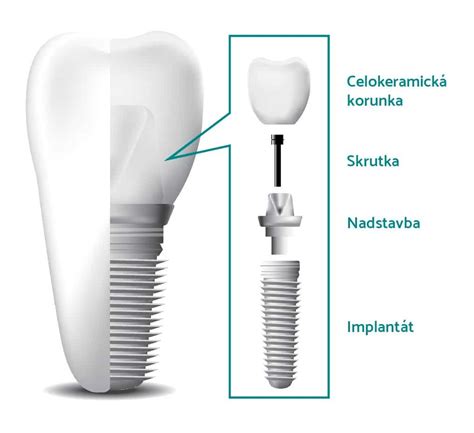zubný implantát v kosti