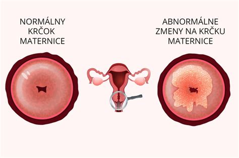 Schéma implantácie vajíčka do steny maternice