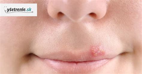 Herpes na perách u dieťaťa