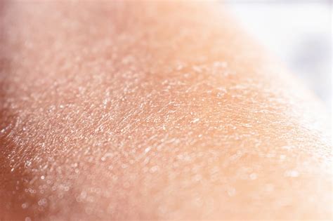 suchá pokožka dieťaťa