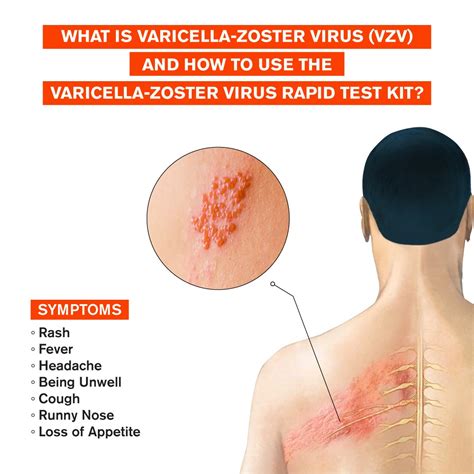Ilustrácia vírusu varicella-zoster