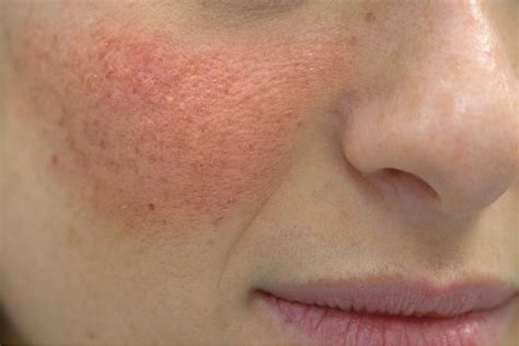 Mapa pokožky s vyznačenými oblastami seboroickej dermatitídy