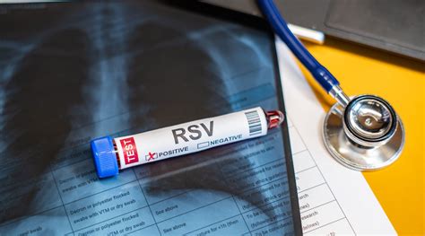 Graf porovnávajúci riziko RSV u predčasne narodených a donosených detí