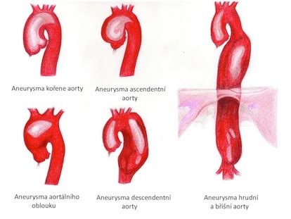 Schéma ľudskej aorty s jej hlavnými časťami
