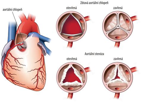 Ilustrácia srdca s vyznačenou aortou a možným miestom koarktácie