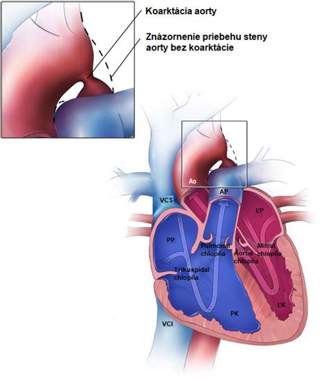 Infografika o koarktácii aorty