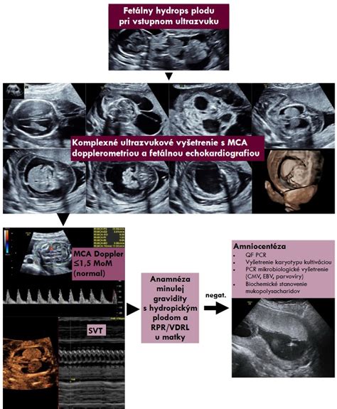 Schéma ultrazvukového vyšetrenia plodu