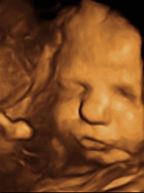 3D ultrazvukové zobrazenie mozgu plodu