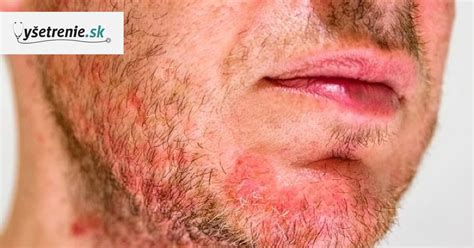 Seboroická dermatitída na tvári dieťaťa
