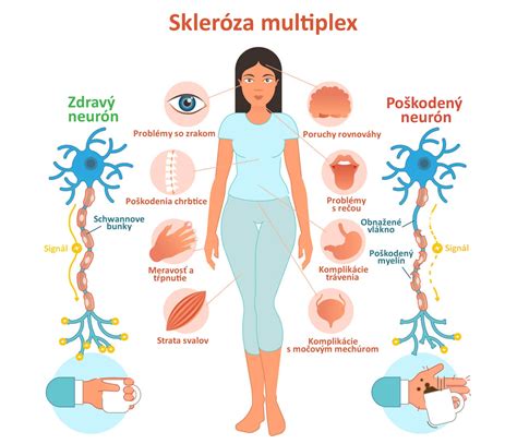 Ilustrácia znázorňujúca príznaky sklerózy multiplex ako únava, problémy so zrakom a brnenie