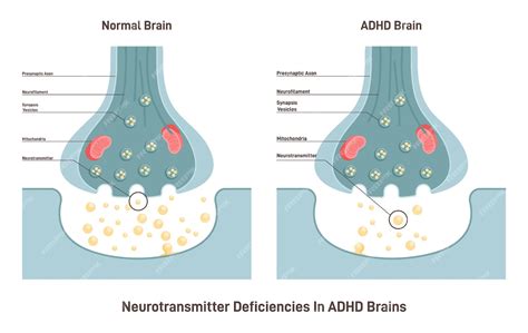 schéma prejavov ADHD