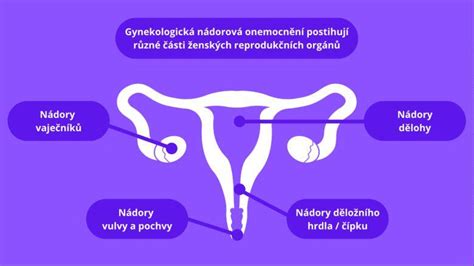 Infografika o bežných gynekologických ochoreniach