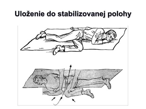 Ilustrácia stabilizovanej polohy u dojčaťa