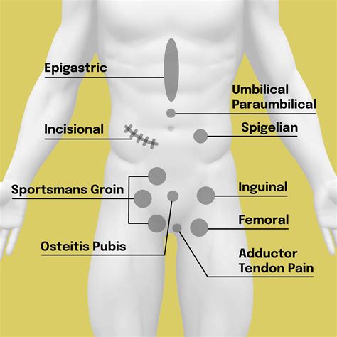 Anatomické znázornenie brušnej steny a hernia